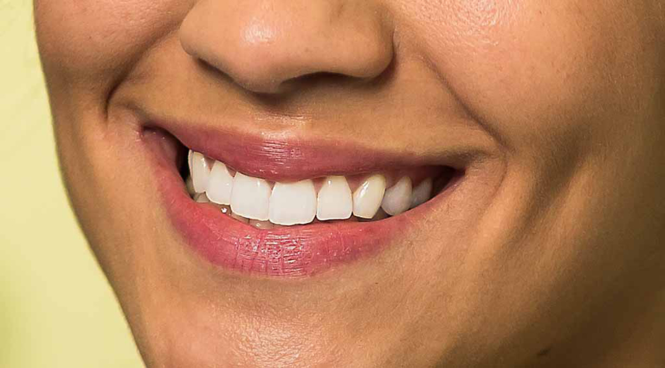 Dentisteria Estética e Branqueamento